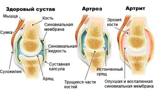Это нужно знать: Разница между артрозом, артритом и остеопорозом