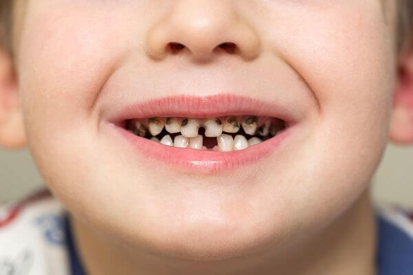 Кариес зубов у детей: Характеристика заболевания